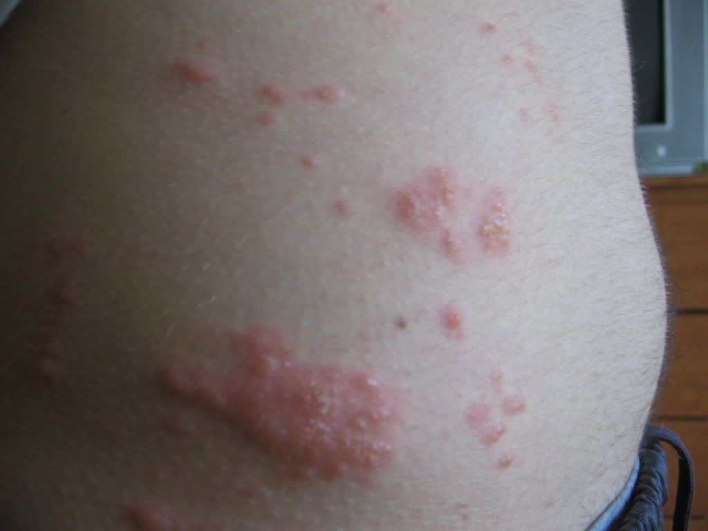red bumps on arms stomach - MedHelp