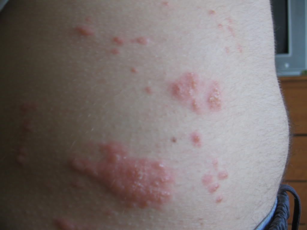 Skin Rash: 59 Pictures, Causes, Treatments - Healthline